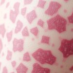 Mottled Skin